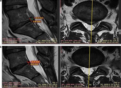 Comparison Of Disc Bulge Size On MRI A Pre Treatment MRI L5 S1