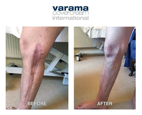 Before And After Leg Injury Skin Camouflage Performance With Multiple