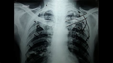 posterior ribs x ray