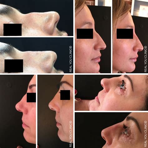 Non Surgical Rhinoplasty 憐 Nose Job Without Surgery Real You Clinic