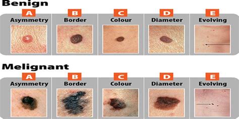 Learn about a rx treatment for metastatic merkel cell carcinoma on the hcp site. merkel cell cancer - pictures, photos