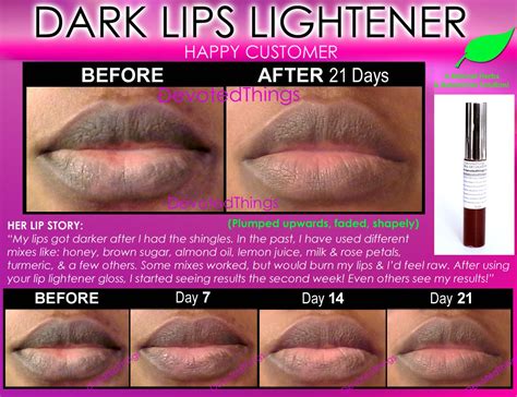 best dark lip lightening natural product whitening treatment to get pink lips