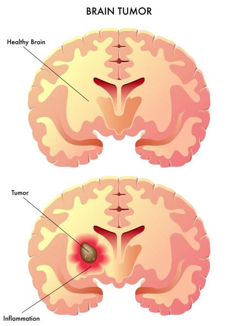 Diagram Brain Tumor Diagram Mydiagram Online