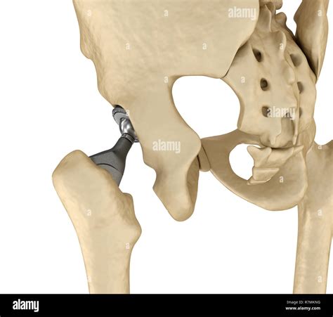 Hip Replacement Implant Installed In The Pelvis Bone Medically