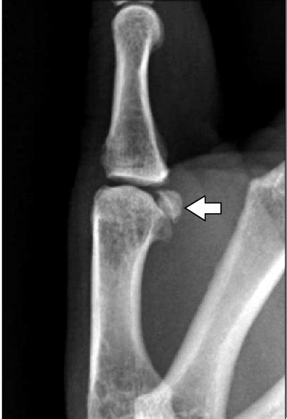 A Lateral Radiograph Shows That The Space Between The Metacarpal And
