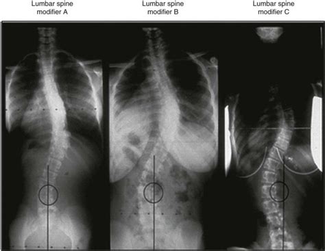 Surgical Treatment Of Adolescent Idiopathic Scoliosis Lenke Curve Types 1 Through 6 Neupsy Key