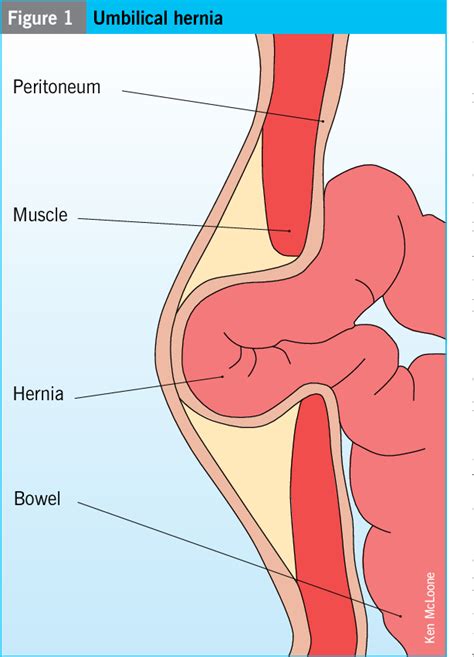 Figure From Congenital And Acquired Umbilical Hernias Examination And Treatment Semantic