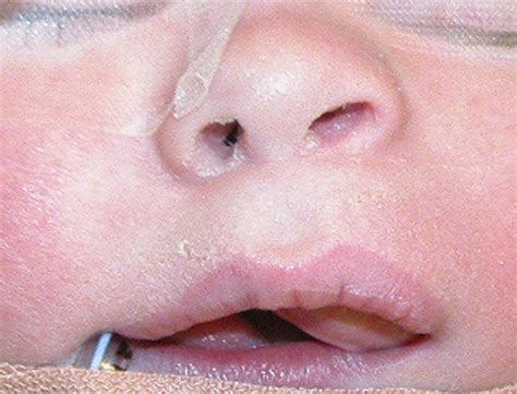Rapidly Growing Intraoral Swelling Involving The Maxilla Of An Infant