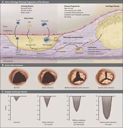 Degenerative Calcific Aortic Stenosis A Natural History Heart