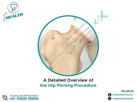 A Detailed Overview Of The Hip Pinning Procedure