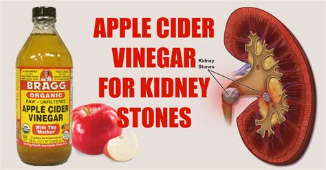 1 baking pan 5 large apples of any kind 1/2 cup of honey 1 handful of raisins 1 handful of walnuts dash of cinnamon. 5 Ways To Use Apple Cider Vinegar To Dissolve Kidney Stones