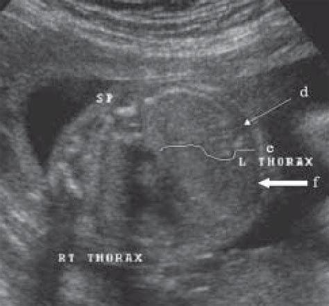 Transverse Usg Of The Fetal Thorax Four Chamber Cardiac View Captured