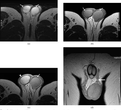 Figure 2 From Mri In The Diagnosis Of Incomplete Testicular Torsion Semantic Scholar