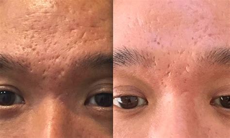 Acne Scar Removal Treatment Before And After Photos