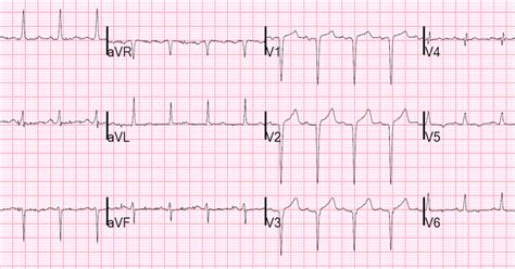 Dr Smiths Ecg Blog St Elevation And Qs Waves Ecg Is Equivocal Use