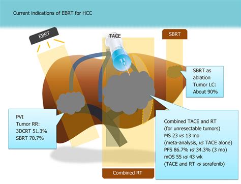 Indications Of External Radiotherapy For Hepatocellular Carcinoma From