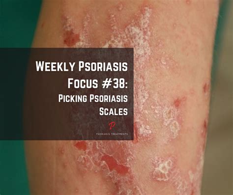 Picking Psoriasis Scales Psoriasis Treatments