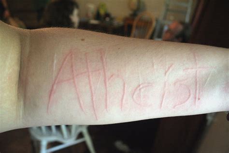 Atheist Dermagraphia Skin Writing Welting Is Caused By Pr Flickr