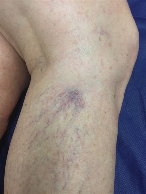 Varicose Vein Removal Glue Laser Ultrasound — The Leg Vein Doctor