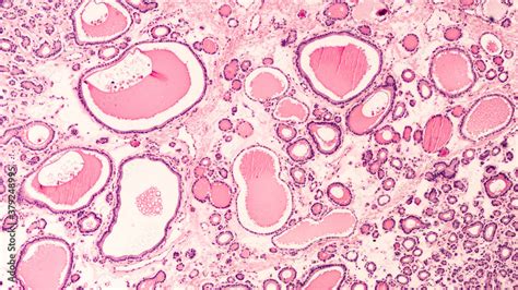 Photomicrograph Showing Histology Of A Benign Thyroid Nodule In A Hot