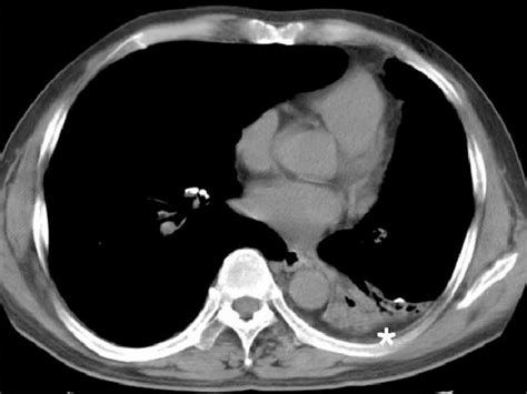 Left Lower Lobe Collapse With Decreased Lung Volume In A 55 Year Old