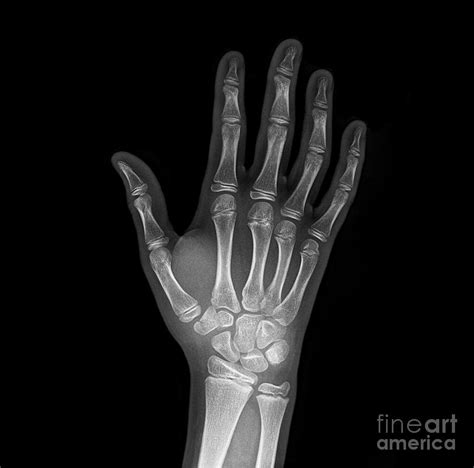 Broken Wrist Bone X Ray Photograph By Science Photo Library Fine Art
