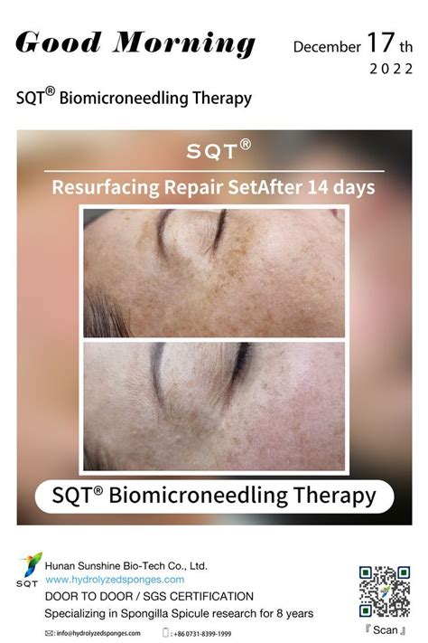 This Is After Only 2 Sqt Biomicroneedling Sessions Not Only Can You