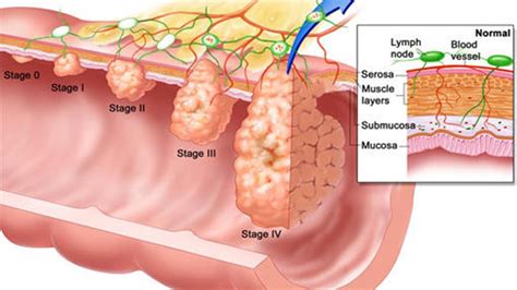 To be on the safe side, tell your doctor about new symptoms such as rectal bleeding,. Colon polyps: Early intervention can prevent colon cancer ...