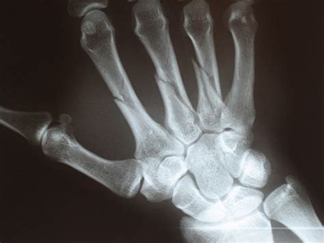 Metacarpal Fractures Steady Hand Sound Mind