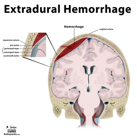 Types Of Intracranial Hematomas Cindy Bou Bruidstaart