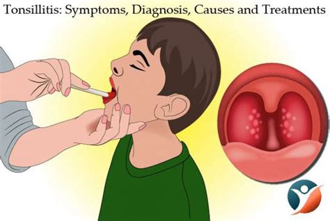 Tonsillitis Symptoms Causes Prevention And Treatments