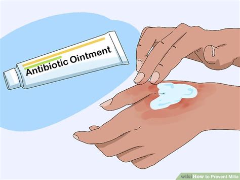 How To Prevent Milia 9 Steps With Pictures Wikihow