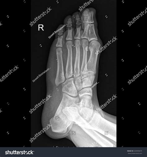 X Ray Right Foot Human Oblique View Stock Photo 320990675 Shutterstock