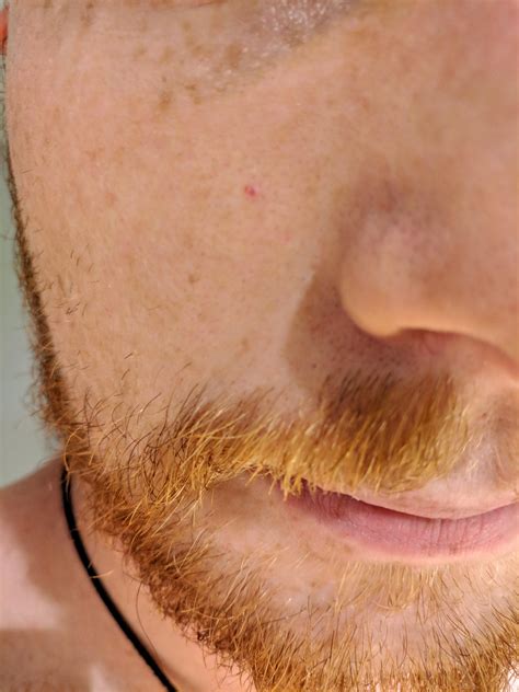 Skin Concerns Red Dot On My Face That Has Been Here For Many Months