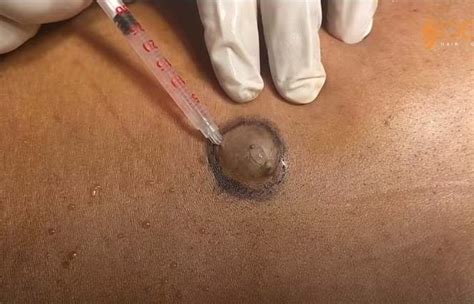 Sebaceous Cyst With Black Pus Removed New Pimple Popping Videos