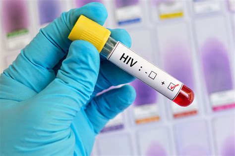 Hiv Positive Blood Sample Stock Photo Download Image Now Istock