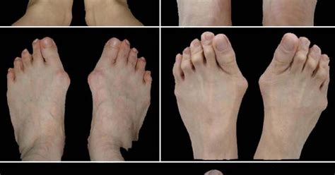 This Picture Illustrates Various Degrees Of Bunion Deformity From Mild To Severe Bunions Also