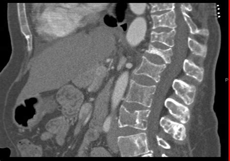 Metastatic Breast Cancer To Bone Musculoskeletal Case Studies