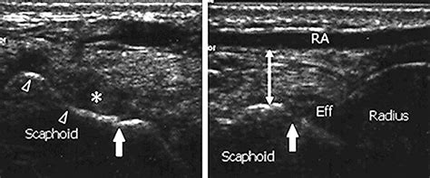 High Spatial Resolution Ultrasonography Hsrs In The Diagnosis Of