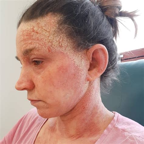 This Womans Skin Has Been Damaged So Much By Steroid Creams That