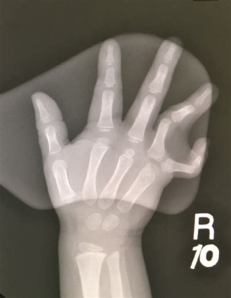 Unusual Extra Finger Congenital Hand And Arm Differences