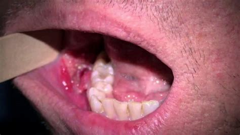 Black Spot Mouth Cancer