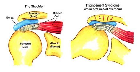 Impingement Syndrome Of The Rotator Cuff Sportsmd