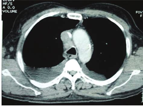 Contrast Enhanced Ct Scan Of The Thorax Showing A Nodular Lesion In The