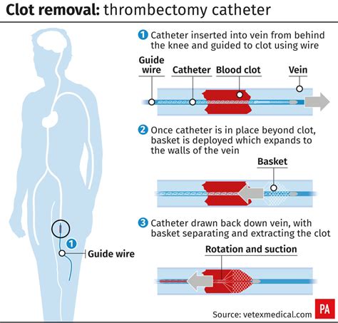 Uk Patient First To Be Treated With Clot Removing Device Bt