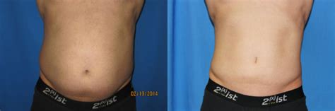 Liposuction Abdomen Flanks Before And After Photo Gallery Coeur D