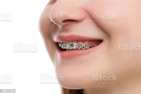 Closeup Multicolored Braces On Teeth Beautiful Female Smile Portrait With Selfligating Braces