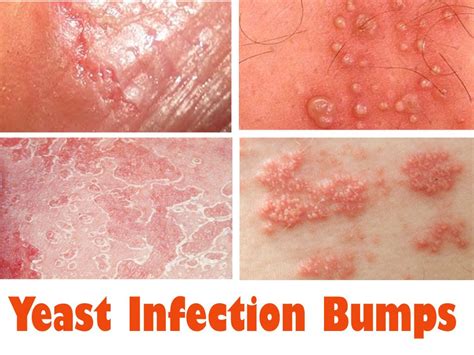 this could probably be yeast infection bumps caused by candida albicans which… yeast infection