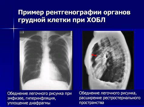 Хронический бронхит и диеты Хронический бронхит. Хроническая обструктивная болезнь легких Хронический бронхит. Хроническая обструктивная болезнь легких Хронический бронхит и диеты