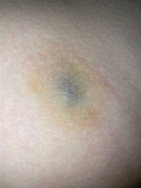 Lump Bruise On Thigh Wont Go Away Rdermatologyquestions